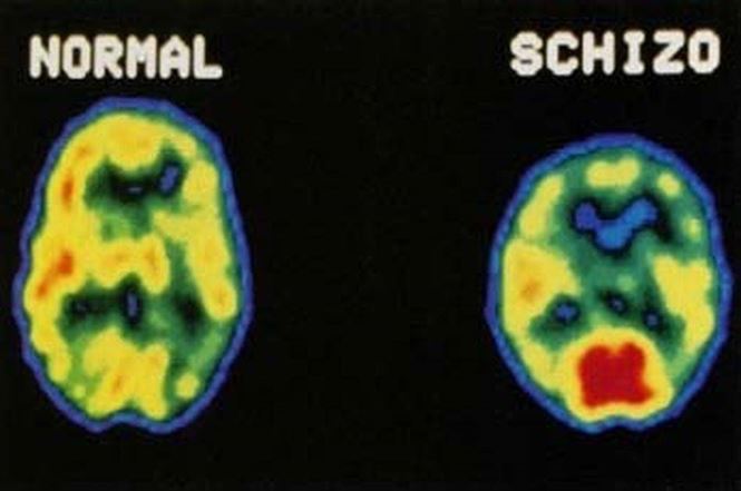Nature - Studiu genetic amplu care ofera o noua perspectiva asupra schizofreniei